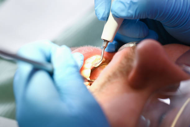 Best Emergency Root Canal Treatment in Whitestown, IN