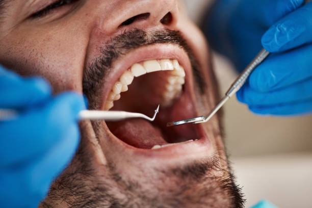 Best Emergency Root Canal Treatment in Whitestown, IN
